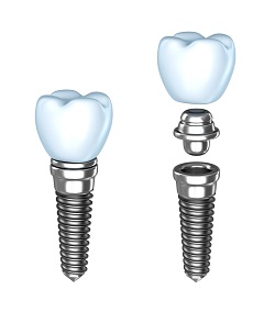 Illustration of Dental Implants, Baltimore, MD